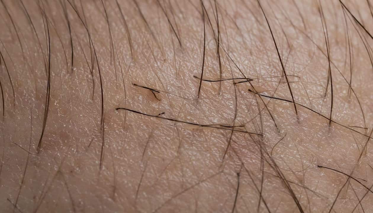 Close-up of hair follicles in resting telogen phase on scalp